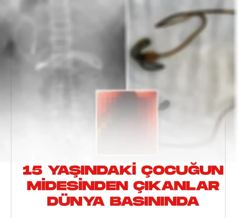 15 yaşındaki çocuğun midesinden çıkanlar şok etti.