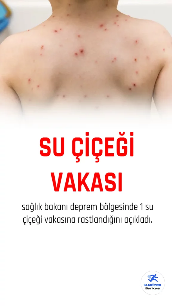 Sağlık Bakanı Koca, deprem bölgesinde bir su çiçeği vakasına rastlandığını açıkladı.