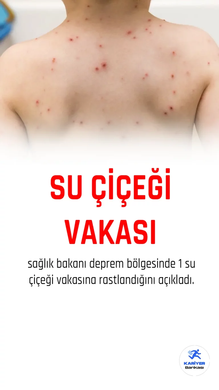 Sağlık Bakanı Koca, deprem bölgesinde bir su çiçeği vakasına rastlandığını açıkladı.